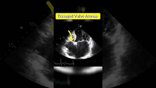 Tricuspid Valve Atresia  Echocardiography For Beginners echocardiogram shorts [upl. by Aierdna706]