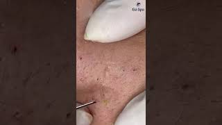 Customers squeeze acne at GaSpa Clinic gaspa phongkhamdalieu acne shortsvideo [upl. by Dhaf150]