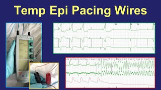 Surgical epicardial pacing wires  uses and management [upl. by Ahseiat464]