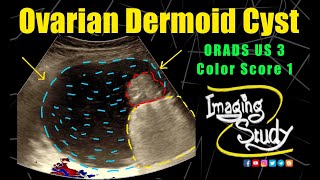 Ovarian Dermoid Cyst  Mature Cystic Teratoma  ORADS 3  Ultrasound  Case 295 [upl. by Madelon303]