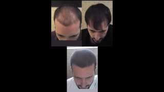 Time Lapse  18 months of hair loss treatment [upl. by Aliban]