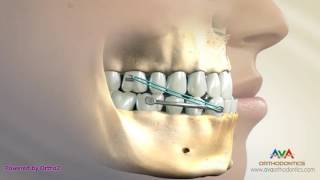 Orthodontic Treatment for Underbite or Crossbite  Carriere Appliance [upl. by Ela]