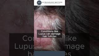 Scarring Alopecia [upl. by Halil]