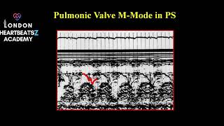 M mode Echocardiography applications Quiz amp Discussion Q MI  CAD MVP Pulmonary hypertension [upl. by Shirlene]