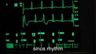 extrasystoles ventricular bigeminus [upl. by Ailehs]