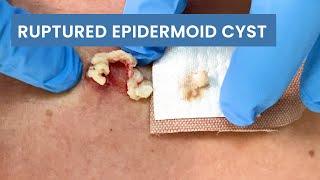 Removing a Ruptured Epidermoid Cyst  CONTOUR DERMATOLOGY [upl. by Garzon]