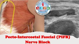 PectoIntercostal Fascial PIFB Nerve Block [upl. by Ithaman222]