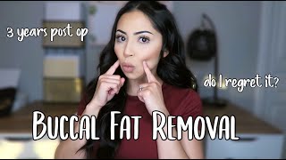 BUCCAL FAT REMOVAL 3 YEAR UPDATE  BEFORE AND AFTER [upl. by Geoff]