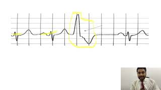 Mastering ECGLesson17 PVCs amp PACs  premature ventricular amp atrial contractions [upl. by Lledo436]