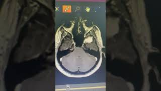 meningioma resection [upl. by Clive]