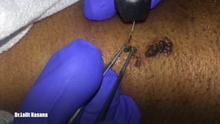 WART REMOVAL Magical Result by DR LALIT KASANA [upl. by Nagaem]