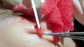 removing intradermal nevus [upl. by Joellen]