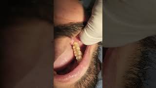 Impacted third molar extraction [upl. by Gilmore]