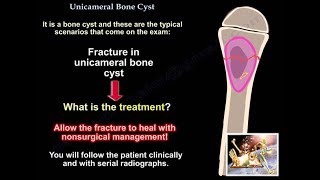 Bone Cyst Unicameral Bone Cyst  Everything You Need To Know  Dr Nabil [upl. by Janetta779]