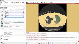 Lung tumor segmentation in a chest CT with 3D Slicer and Local Threshold effect [upl. by Aniretak]