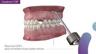 Système CT8®  Pose CT81 zygomatique [upl. by Adnamahs]