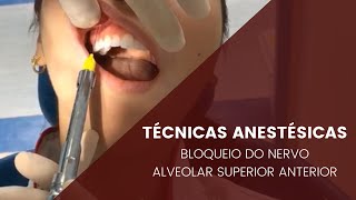 Técnicas anestésicas bloqueio do Nervo Alveolar Anterior [upl. by Norym]