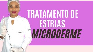 Tratamento de estrias Microderme [upl. by Ecirtaed]