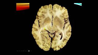 Neurology Exam Cranial nerves I and II [upl. by Namajneb]