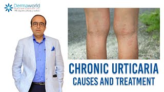 Chronic Urticaria  causes and treatment  Chronic Hives  Dr Rohit Batra [upl. by Leksehcey623]