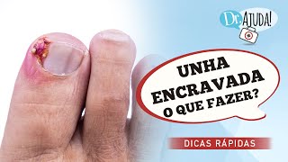 UNHA ENCRAVADA O QUE FAZER [upl. by Wolfe]