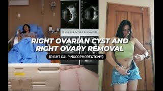 RIGHT OVARIAN CYST AND RIGHT OVARY REMOVAL [upl. by Tibold479]