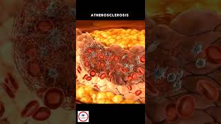 Atherosclerosis 🩸 [upl. by Graaf]