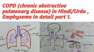 COPD chronic obstructive pulmonary disease in HindiUrdu Emphysema in detail part 1 [upl. by Sivehc]