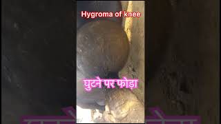 Hygroma of knee l dr Umar Khan [upl. by Renferd]