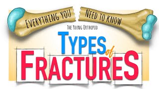 Bone Fracture Types amp Mechanisms  ANIMATION  Fracture classification  The Young Orthopod NEET PG [upl. by Carina]