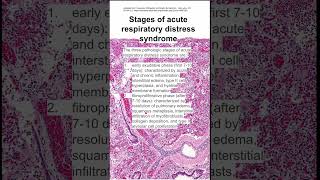 Stages of acute respiratory distress syndrome [upl. by Cormac]