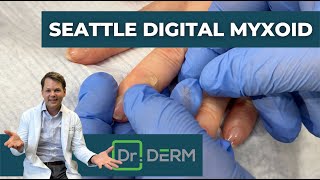 Digital Myxoid from Seattle  Dr Derm [upl. by Derag]