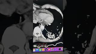 Pulmonary sequestration with small thoracic aorta branch [upl. by Newman]