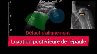 Luxation Postérieure de lÉpaule Échographie Glénohumérale Posterior shoulder dislocation [upl. by Ettelrac752]