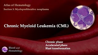 Chronic Myeloid Leukemia CML [upl. by Eardnoed689]