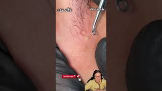 blackheads nose blackheads removal satisfying blackheads removal lips blackheads removal ear [upl. by Had]