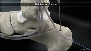 Transfert du long fléchisseur de lhallux FHL  Rupture du tendon dAchille  Dr Simon Tournemine [upl. by Selinda580]