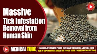 Tickpocalypse  Removal of a Huge Tick Infestation from Human Skin [upl. by Waterer26]