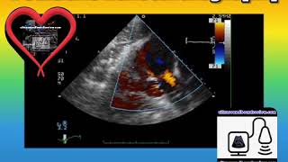 Total Anomalous Pulmonary Venous Return [upl. by Ferwerda369]