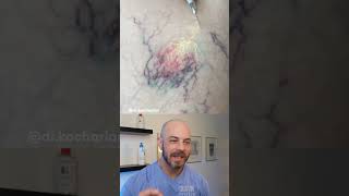 Dermatologist reacts to super satisfying vein therapy dermreacts doctorreacts veintherapy [upl. by Lirbaj]