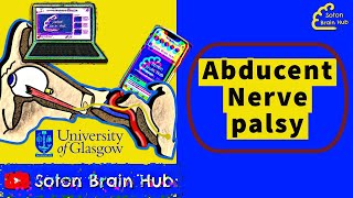 Abducent Nerve palsy [upl. by Anyzratak]