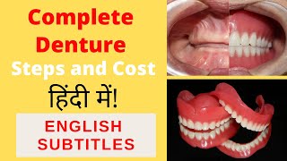 Complete denture procedure in Hindi by Dr Akash ShahEnglish Subtitles [upl. by Yennaiv654]