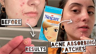 TESTING NEXCARE ACNE ABSORBING PATCHES FOR MY ACNE  Hydrocolloid Patches Results [upl. by Charbonnier]