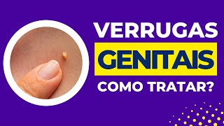 Como tratar verrugas genitais [upl. by Nedrud]