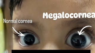 Normal corneal Diameter VS Megalocorneal Diameter  Optometry Solutions [upl. by Stefanac]