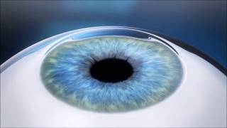 Cirurgia Refrativa a Laser  Lasik [upl. by Aneryc]