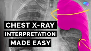 Chest Xray Interpretation  How to Read a CXR  OSCE Guide  UKMLA  CPSA [upl. by Ellebyam]