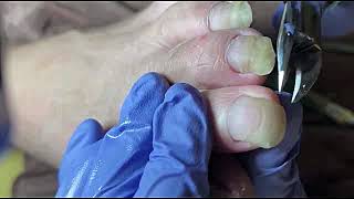 DIY Ingrown Toenail Removal  How to Safely Cut Ingrown Toenails at Home [upl. by Aelram]