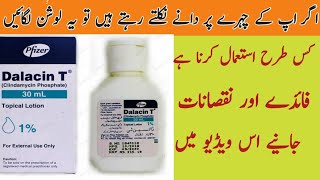 Acne pimple solution  get rid off acne marks  Dalacin T lotion review uses benefits amp Side effects [upl. by Nessy990]