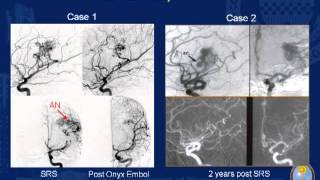 Stereotactic Radiosurgery for Arteriovenous Malformations with Hemorrhage History [upl. by Enait]